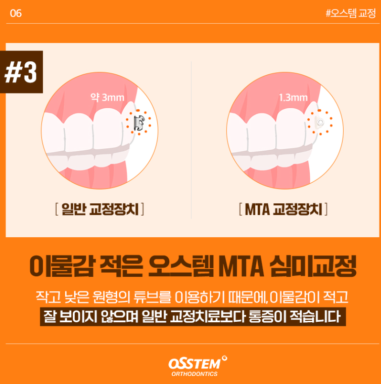 앞니 부분교정, 언제 고려할 수 있을까?